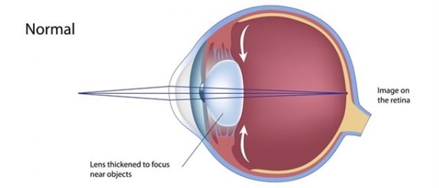 Presbyopia