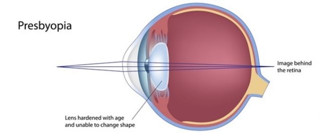 Presbyopia