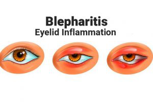 Eyelid-Inflammation-cao-thang-eye-hospital