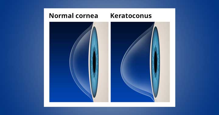 Keratoconus-condition