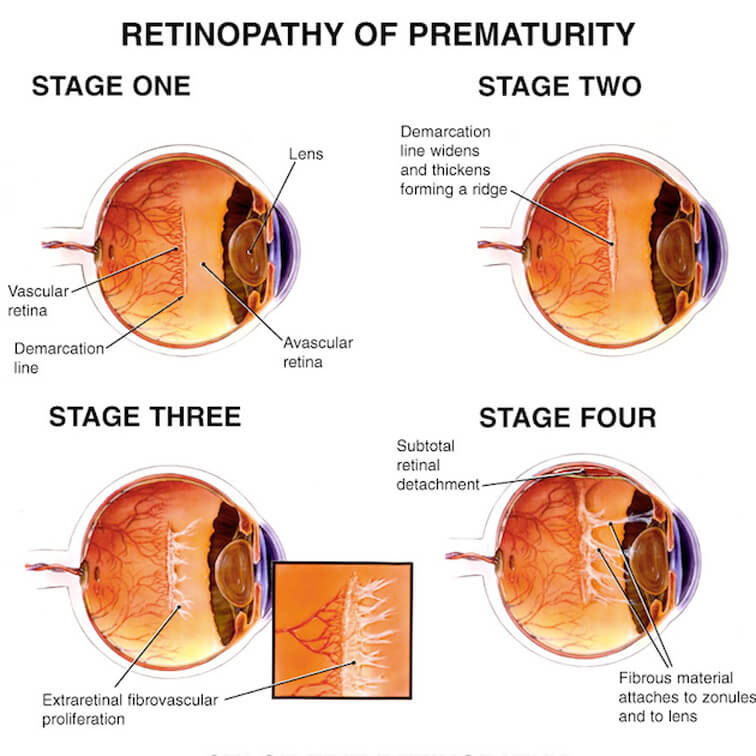 4 stages of ROP diseases should be considered for an proper treatment to protect vision 