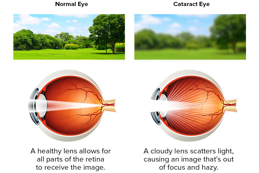 cataracts-Cao thang hospital