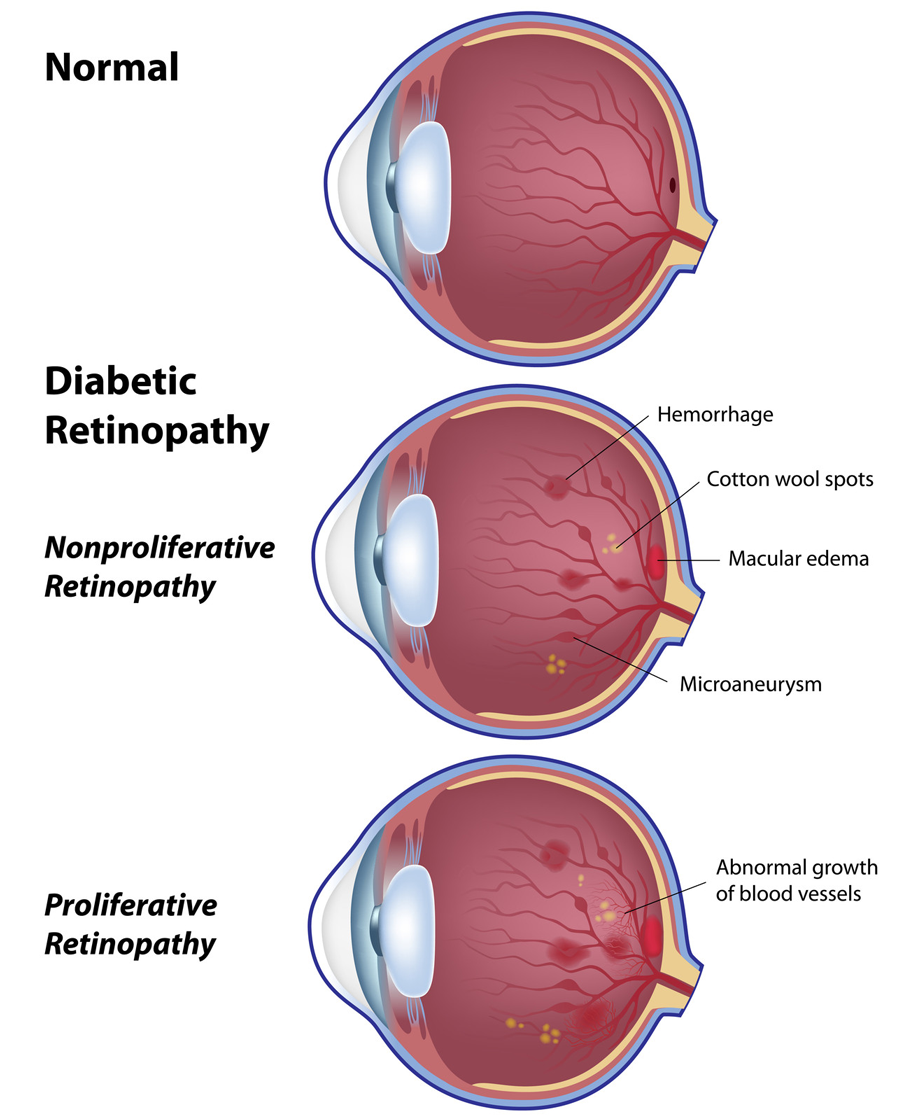 diabetic-retinopathy-stages-cao-thang-eye-hospital