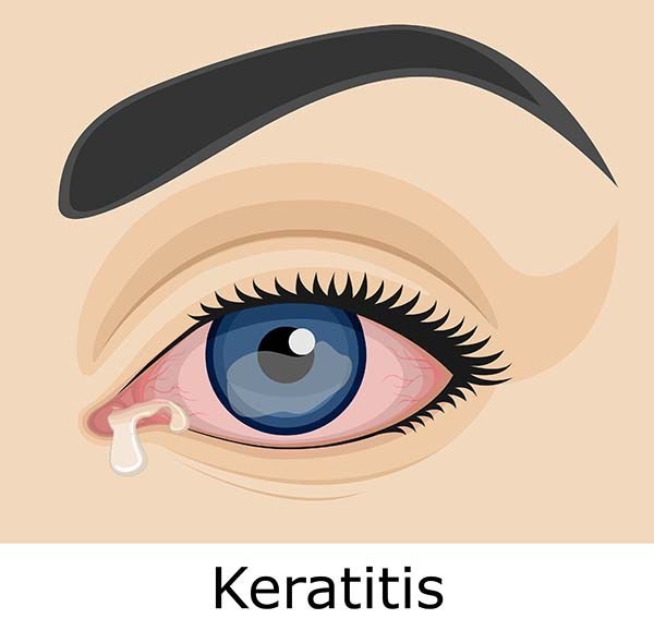 keratitis symptoms cao thang eye hospital