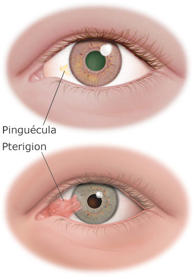 pterygium&pinguecula