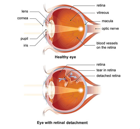 retinal_detachment-cao-thang-eye-hospital